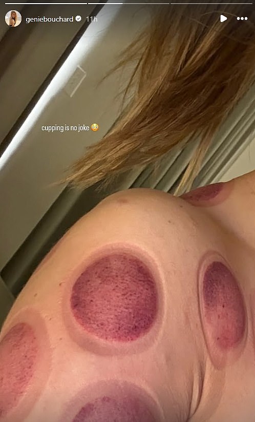 Tennis glamour girl Eugenie Bouchard reveals the brutal results of cupping treatment – just days after celebrating her birthday with friends in New York